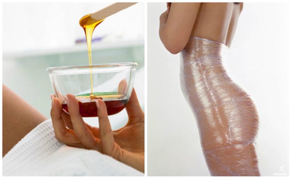 Περιτυλίξεις σώματος για απώλεια βάρους